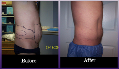 Tummy before and after laser lipo