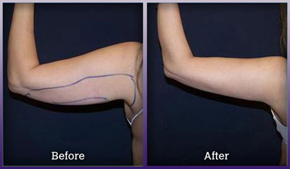 Liposuction of the arm