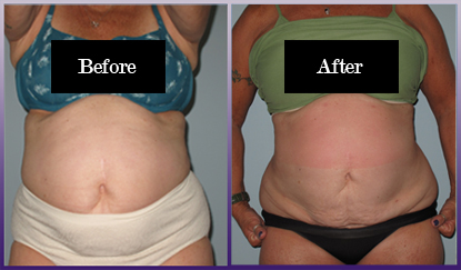 Abdomen before and after tumescent lipo