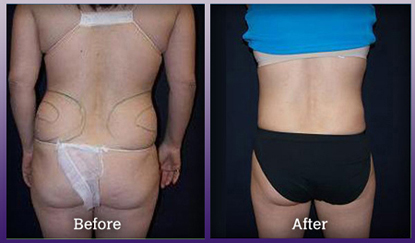Liposuction - back