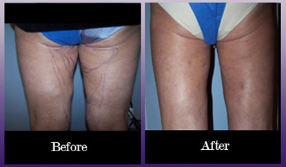 Inner thighs before and after laser lipo