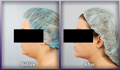 Before and After Chin