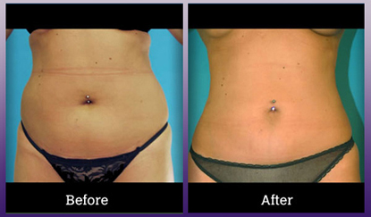 Laser-assisted liposuction of abdomen