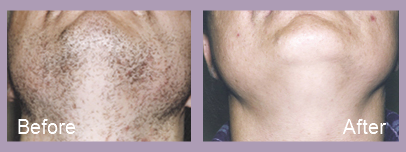 Chin Before & after laser har removal on the chin
