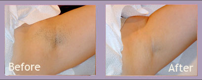 Bikini Before & after Underarm