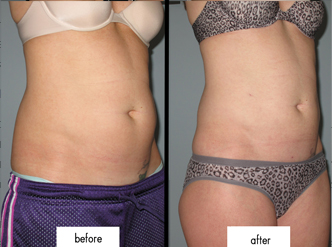 Tummy Lipo