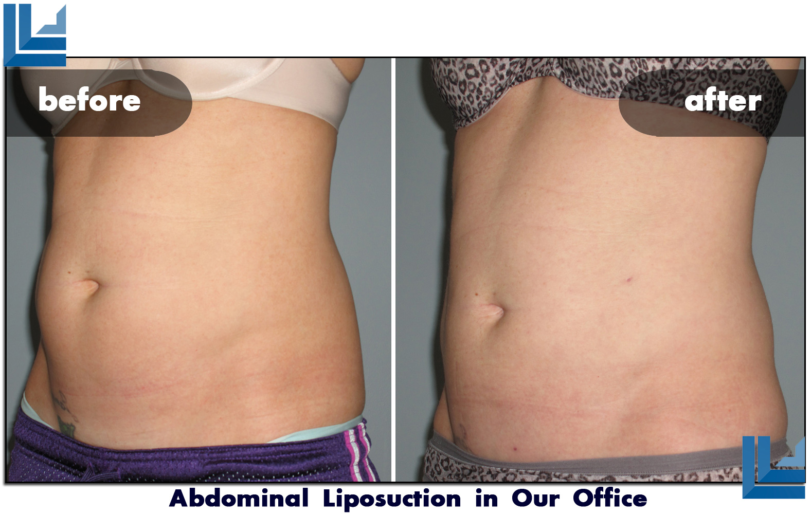 Abdominal Liposuction St. Louis Laser Liposuction Center