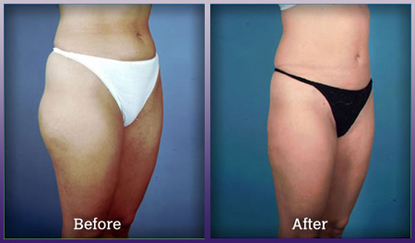 What are the average results for thigh liposuction?