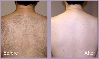 Best options for back hair removal