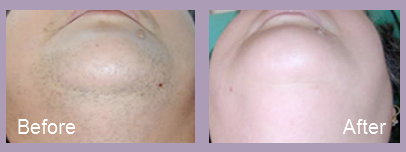 Before and After Laser Hair Removal | St. Louis Cosmetic Surgery Center