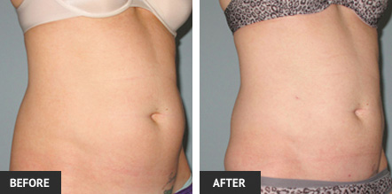 lipo-ba1