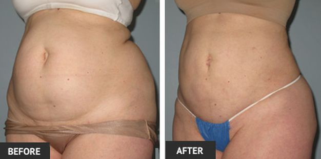 One of Our Patient's Abdominal Liposuction Results One of our female patients who opted to undergo an abdominal liposuction treatment.