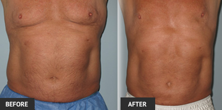 Patient Who Underwent an Abdominal Liposuction Procedure A picture showing the results of this particular patient's abdominal liposuction procedure.