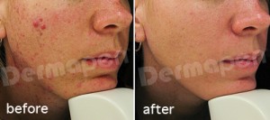 Firsthand Dermapen Results On Scar Removal A photo of one woman's outstanding dermapen results taken in our office.