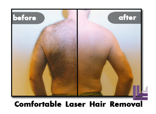 The Effects Laser Hair Removal Can Have Patient who decided to undergo his hair removal procedure in St. Louis, MO's best liposuction center.