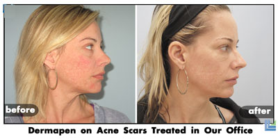 Before and After Her Dermapen Treatment The effects the dermapen treatment can have on one's acne scars.