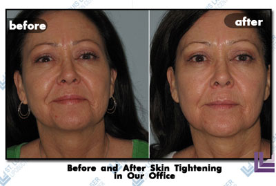 Results of Her Skin Tightening Procedure Before and after this woman's skin tightening procedure in the St. Louis laser Liposuction Center.