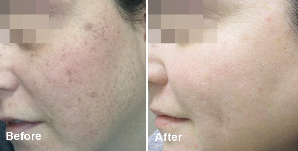 Female Patient Who Underwent Our Lumecca Treatment The difference before and after the Lumecca laser treatment was utilized.