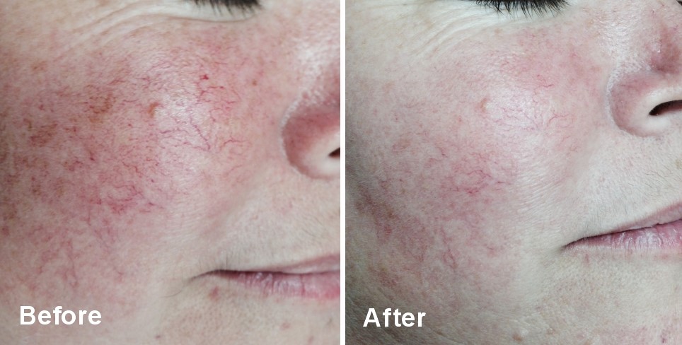 Red Light Therapy - Before and After The effects of red light therapy on reddish skin located on the face and cheek.