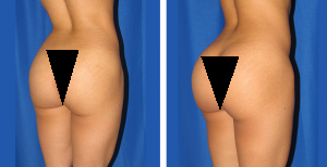 Before and After the Buttocks Fat Transfer Woman who underwent a fat transfer procedure to improve the look of her butt.