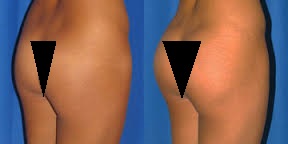 Firsthand Results of The Fat Transfer Procedure The effects of a fat transfer procedure on the buttocks.