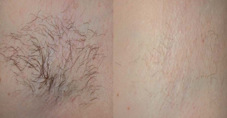 Close-Up of the Effects of Diolaze A close-up shot of what Diolaze can do for either the male or female patient.