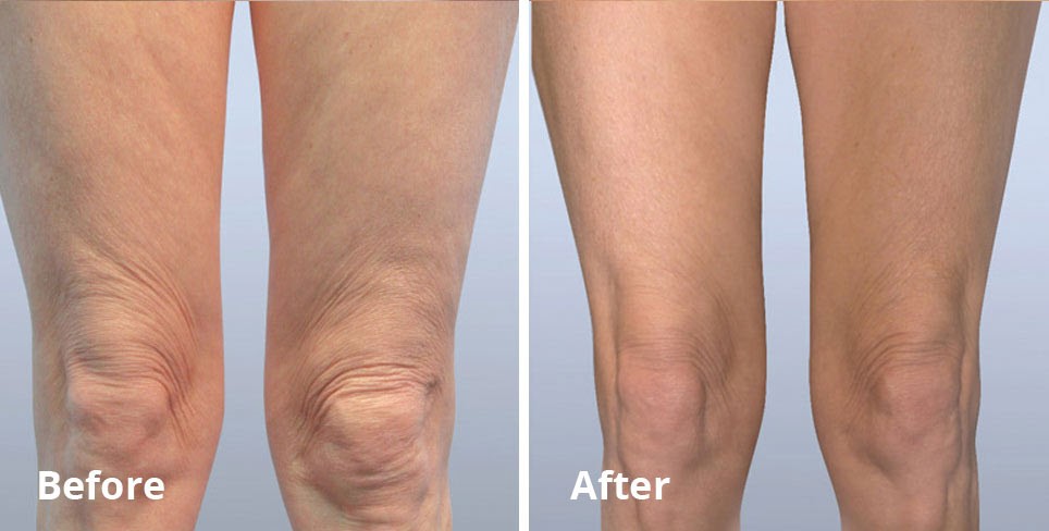 Forma Treatment For Sagging Skin St Louis Laser Liposuction Center how-to-get-rid-of-loose-skin-after-weight-loss-dr-berg-on-saggy