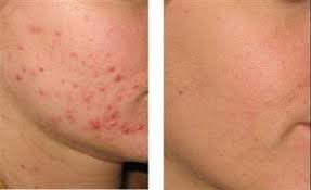 Fractora Results on One Patient's Face Pictures before and after this particular patient's Fractora treatment.