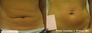 An example of how Fractora can enhance the look of a patient's abdominal region. The Results of Fractora on the Abdomen