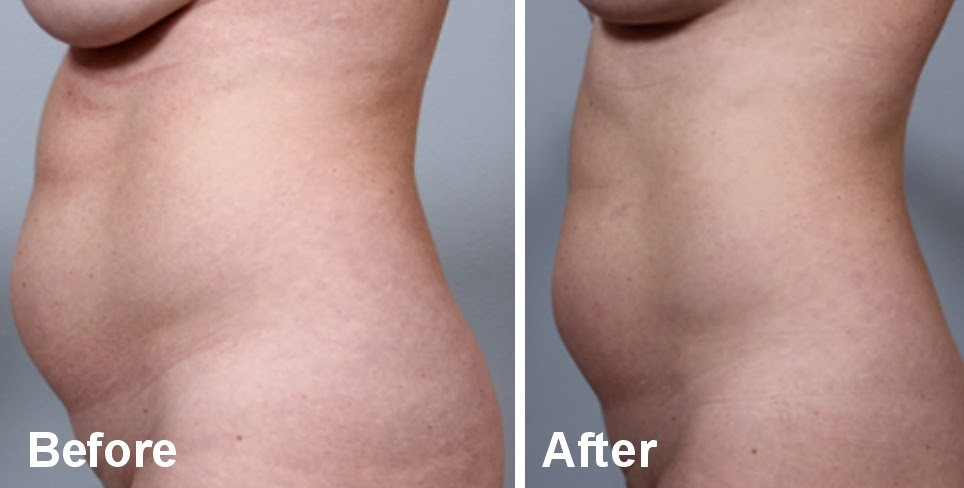 Body Sculpting with BodyFX in St. Louis | St Louis Laser Liposuction Center