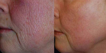 The Chemical Peel Skin Treatment chemical peels st. louis before and after