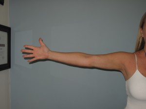After Her Underarm procedure Picture taken after this woman underwent one of the arm liposuction treatments we offer.