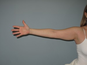 Candidate For Underarm liposuction surgery Before this patient opted for one of our minimally invasive arm liposuction procedures.