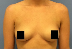 After Her Arm Liposuction Treatment How our arm liposuction procedure has improved the aesthetics of this woman's underarm area.