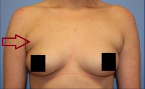 Before She Underwent An Arm Liposuction Procedure The area where our posterior axilliary liposuction will be targeted.