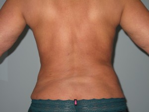 Fantastic Results After Patient's Bra Line Liposuction An image of the same female patient directly after her bra line liposuction treatment.