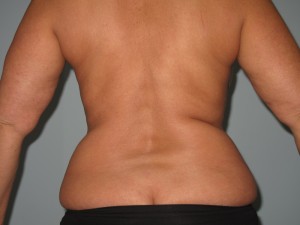 Before For Her Bra Line Liposuction Shot of a female patient before she underwent her bra line liposuction procedure.