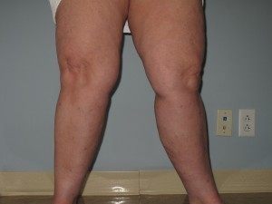 Before Undergoing a Calf Reduction Procedure A picture of the same patient after her calf reduction surgery had been completed.