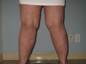 Woman Who Underwent Calf Reduction Surgery The same patients legs seen directly after their calf reduction surgery.