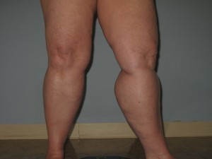 Before Undergoing a Calf Reduction Procedure A picture of one of our patient's before they underwent calf reduction surgery.