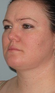 Results of One Patient's Chin Reduction Procedure fA picture of the results taken after this patient had succesfully completed her chin reduction surgery.