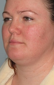 Picture Taken Before Her Chin Reduction Woman interested in receiving a chin reduction from the St. Louis laser Liposucton Center.