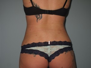 After the Patient's Flank Surgery One example of how flank surgery can improved the aesthetics of one's back.