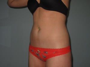 Patient Scheduled For Lipo of the Flanks A female patient preparing to undergo lipo of the flanks at our St. Louis liposuction center.