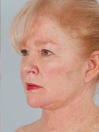 Patient After Chin Reduction Surgery Image of a woman who has recently completed a chin reduction and is happy with her results.