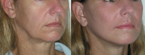 Before and After Chin Reduction Treatment One woman's chin reduction results as documented by these before and after photographs.