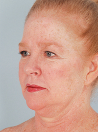 Patient Planning to Undergo a Chin Reduction Photograph taken prior to this patient's upcoming chin reduction surgery.