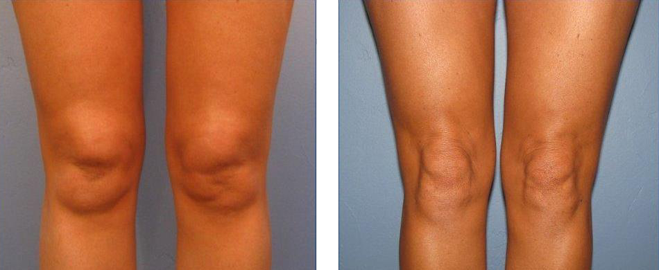 A Look At Lipo On the Knees The results that lipo on the knees has been shown to offer on some occasions.