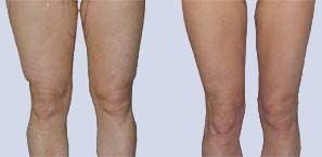 Excellent Knee Liposuction Results Atypical results of lipo on the knees, as shown by one of our patients'.