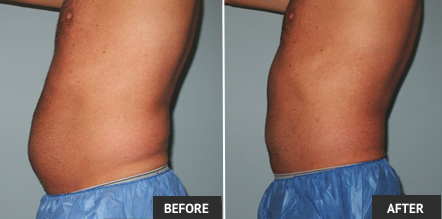 Liposuction Or Weight Loss weight loss with liposuction in st louis st Liposuction Or Weight Loss weight loss with liposuction in st louis st